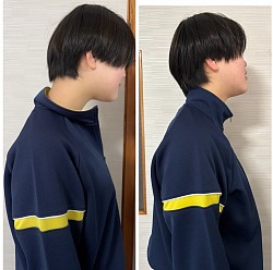 中学１年生の患者さんの施術前後