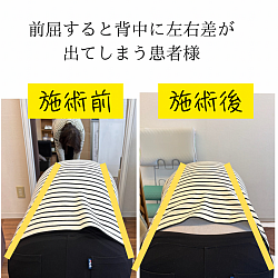 ねじれがある患者さんの施術前後